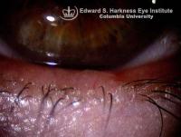 Meibomitis may sometimes simulates malignant lesion.